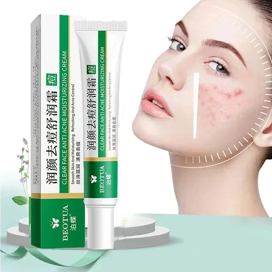 Herbal Acne Cream